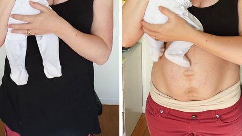 Μια γενναία μαμά δείχνει πώς ακριβώς είναι το σώμα της μετά τη γέννα