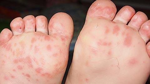 Κόκκινες κηλίδες στις πατούσες νηπίου