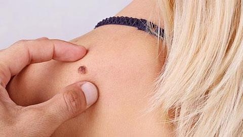 Kαρκίνος του δέρματος: Τα επικίνδυνα σημάδια και πώς να προστατευτείτε