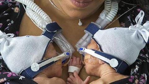 Πρόωρα δίδυμα κρατιούνται χέρι-χέρι αμέσως μετά τον τοκετό!