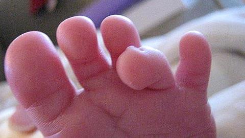 Στραβό δάχτυλο στο πόδι