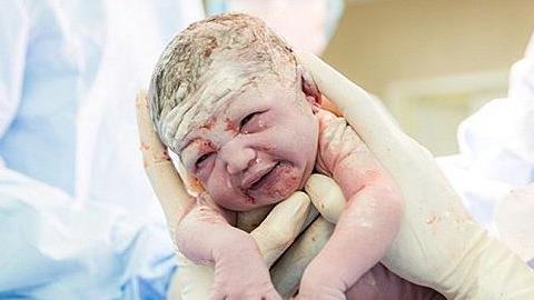 Μια απίστευτη καισαρική: Μητέρα ξεγεννά η ίδια το μωρό της!