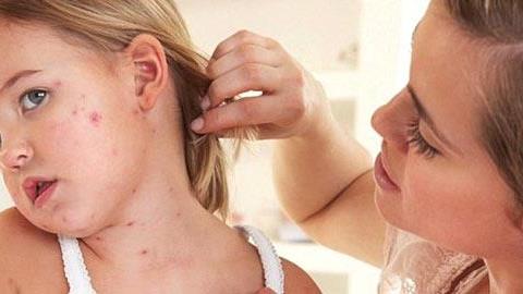 Οστρακιά:  Όσα πρέπει να ξέρετε για να προστατεύσετε το παιδί