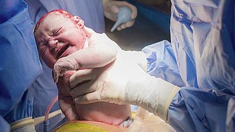 Η νέα μέθοδος καισαρικής που θυμίζει φυσιολογικό τοκετό 