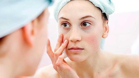 Γιατί έχω μαύρους κύκλους και πώς θα τους «ξεφορτωθώ»;