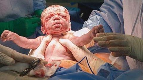 Ένα συγκλονιστικό βίντεο μιας... διαφορετικής καισαρικής