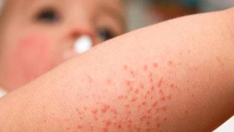 Οι πιο συχνές καλοκαιρινές ασθένειες των παιδιών και πώς να τα προστατεύσετε