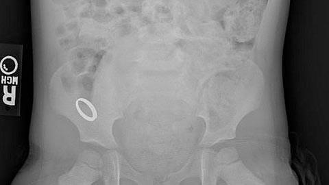 Η κόρη μου κατάπιε ένα βραχιολάκι και δεν το έχω βρει στα κόπρανά της. Να ανησυχήσω; 