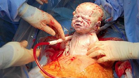 Μητέρα μαγνητοσκοπεί την καισαρική της: Ένα συγκλονιστικό βίντεο