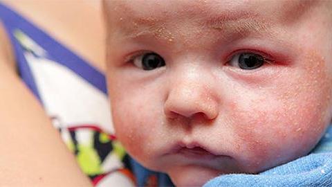 Εξανθήματα