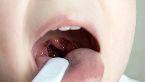 Πώς θα καταλάβω ότι το παιδί μου έχει κρεατάκια και πότε είναι απαραίτητη η επέμβαση