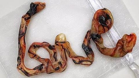 Τέχνη από… ομφάλιο λώρο: Δείτε τι έκαναν αυτές οι μαμάδες