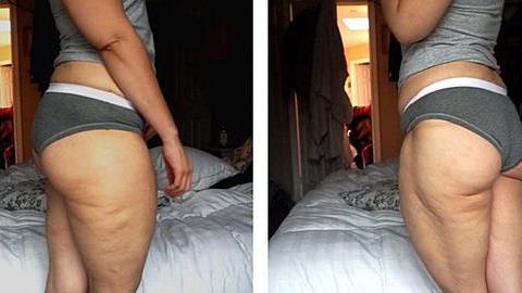 Γιατί αυτή η γυναίκα «ανεβάζει» κάθε Σάββατο φωτογραφίες με κυτταρίτιδα