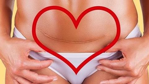 3 μεγάλες αλήθειες για τις μαμάδες που έχουν κάνει καισαρική