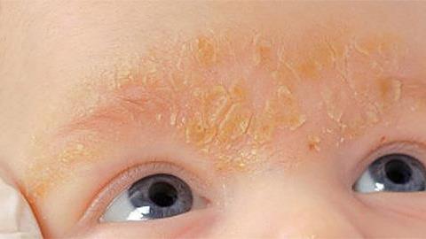 Τι είναι η βρεφική νινίδα και πώς να την αντιμετωπίσετε