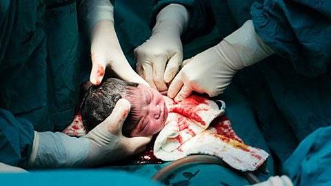 Οι καισαρικές φαίνεται να επηρεάζουν την ανθρώπινη εξέλιξη