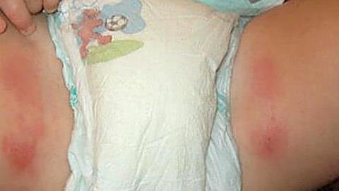 5 μικρά αλλά ενοχλητικά προβλήματα υγείας στα μωρά και πώς να τα ανακουφίσετε