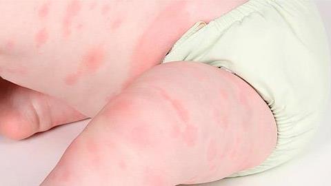 Τροφικές αλλεργίες στα παιδιά: Όσα πρέπει να γνωρίζετε για να τα προστατέψετε