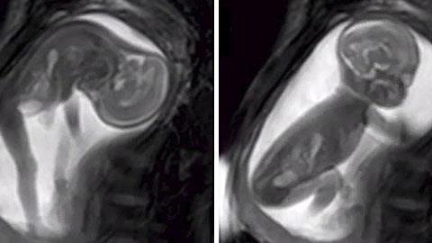 Νέα μέθοδος λεπτομερούς απεικόνισης του εμβρύου μέσω... βίντεο!