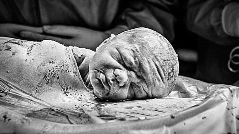 Μια διαφορετική καισαρική: 15 μοναδικές φωτογραφίες