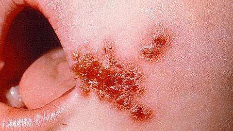 Σταφυλόκοκκος: Τι είναι και πώς εμφανίζεται