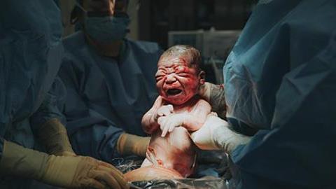 14 συγκλονιστικές φωτογραφίες καισαρικής