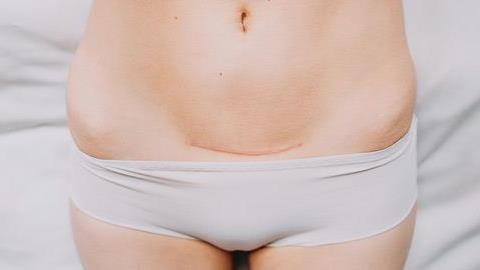 Πρώτη η Ελλάδα στις καισαρικές τομές σύμφωνα με τον ΠΟΥ