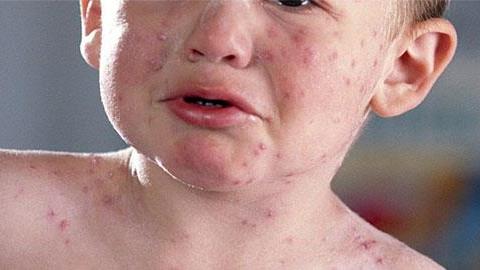 Βρεφική ροδάνθη: Τι είναι και πώς αντιμετωπίζεται