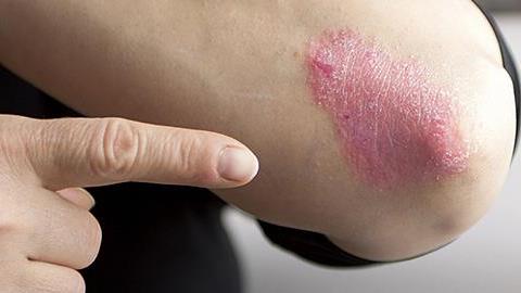 5 δερματικές παθήσεις που «φουντώνουν» με το στρες