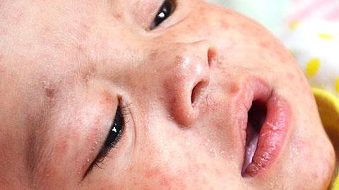 Ανησυχητική έξαρση ιλαράς στις χώρες που έχουν μειώσει τον εμβολιασμό