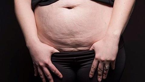 13 μαμάδες εξηγούν γιατί είναι περήφανες για την ουλή της καισαρικής τους