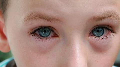 Ερεθισμένα παιδικά μάτια: Να ανησυχήσετε ή όχι