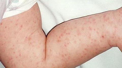 Μηνιγγίτιδα: Πώς θα προφυλάξετε το παιδί από την επικίνδυνη νόσο