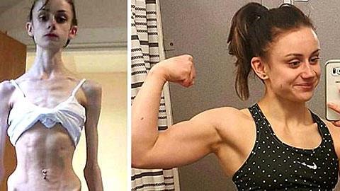 15 άνθρωποι που κατάφεραν να νικήσουν την ανορεξία!