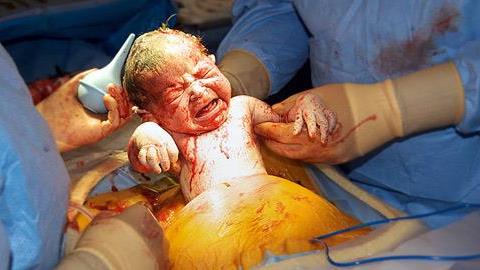 To συγκλονιστικότερο βίντεο καισαρικής που έχετε δει ποτέ!