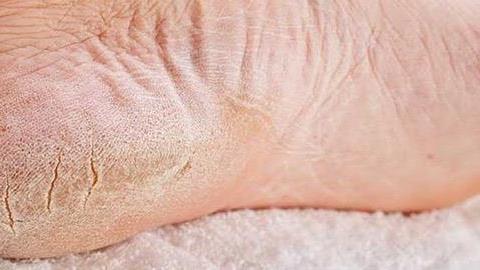 8 εύκολοι τρόποι να απαλλαγείτε από τις σκασμένες φτέρνες