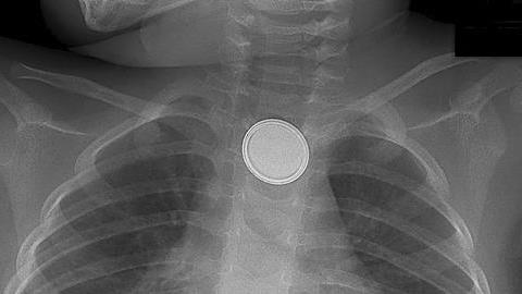 Το απλό καθημερινό αντικείμενο που στέρησε τη ζωή ενός παιδιού