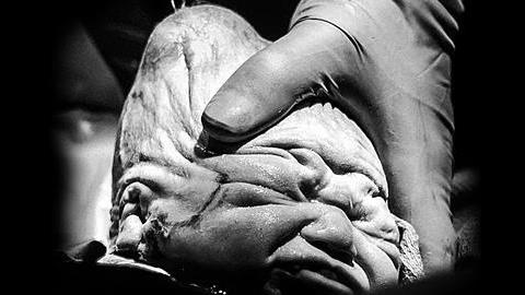 Δείτε τι συνέβη στο κεφάλι αυτού του νεογέννητου κατά την διάρκεια του τοκετού! 