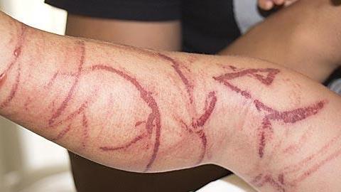 Τι να κάνετε αν σας τσιμπήσει τσούχτρα ή μέδουσα