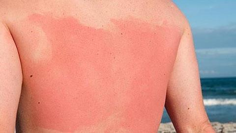 Έρευνα: Οι γονείς δεν προφυλάσσουν επαρκώς τα παιδιά από τον ήλιο!