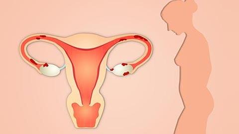 Τι είναι η ενδομητρίωση και πώς επηρεάζει τη γονιμότητα