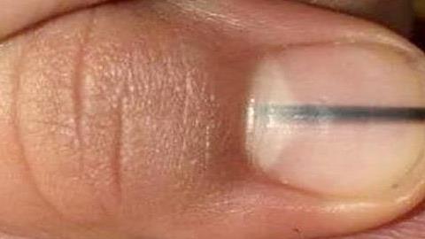 Πώς ανακάλυψε αυτή η γυναίκα ότι έχει μελάνωμα