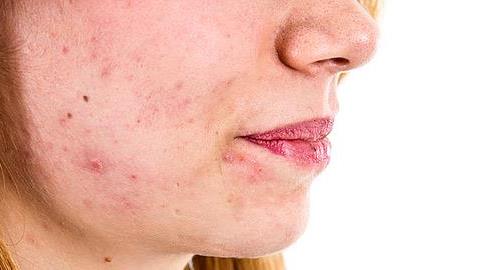 Τι πρέπει να τρώτε για να αποκτήσετε τέλειο δέρμα