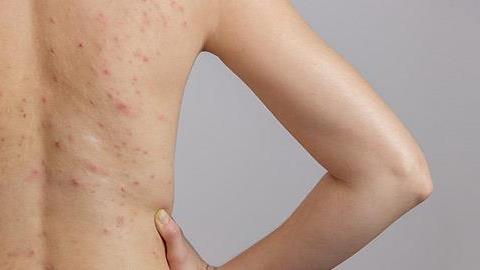 Πώς να εξαφανίσετε τα ενοχλητικά σπυράκια από την πλάτη