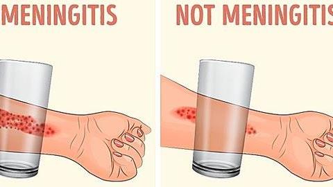 7 συμπτώματα που μαρτυρούν ότι το παιδί πάσχει από μηνιγγίτιδα