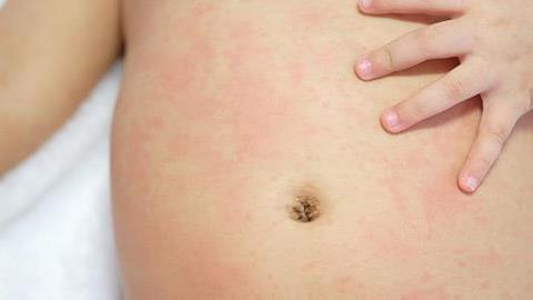 Μηνιγγίτιδα Β: Μετάδοση, συμπτώματα και πρόληψη 