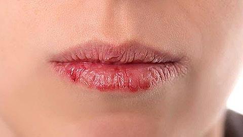Τι μαρτυρούν τα χείλη για την κατάσταση της υγείας σας