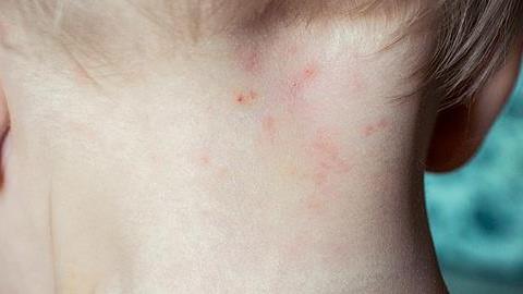 5 φυσικά συστατικά για την αντιμετώπιση δερματικών ερεθισμών