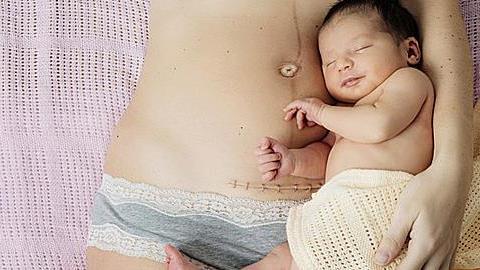 Μπορώ να κάνω και τέταρτη καισαρική;