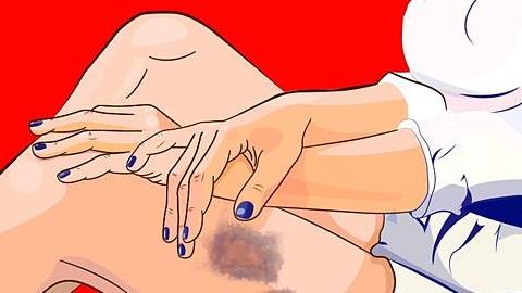 Γιατί μελανιάζω με το παραμικρό; 9 πιθανές αιτίες